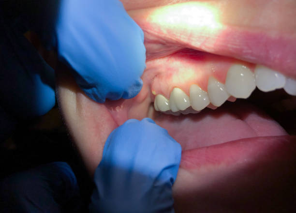 Best Emergency Denture Repair in Brooklawn, NJ
